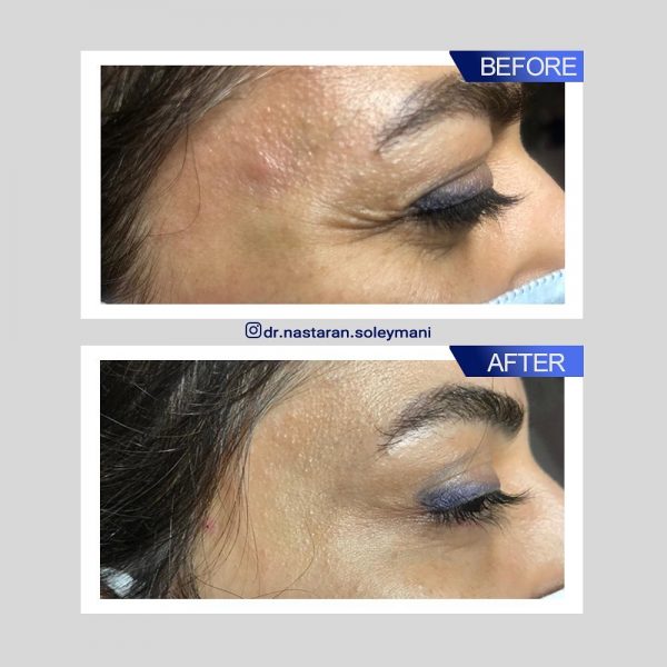 تزریق بوتاکس پنجه کلاغی