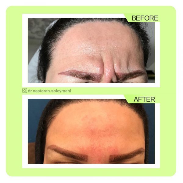 تزریق بوتاکس پیشانی