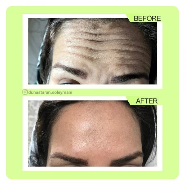 تزریق بوتاکس پیشانی