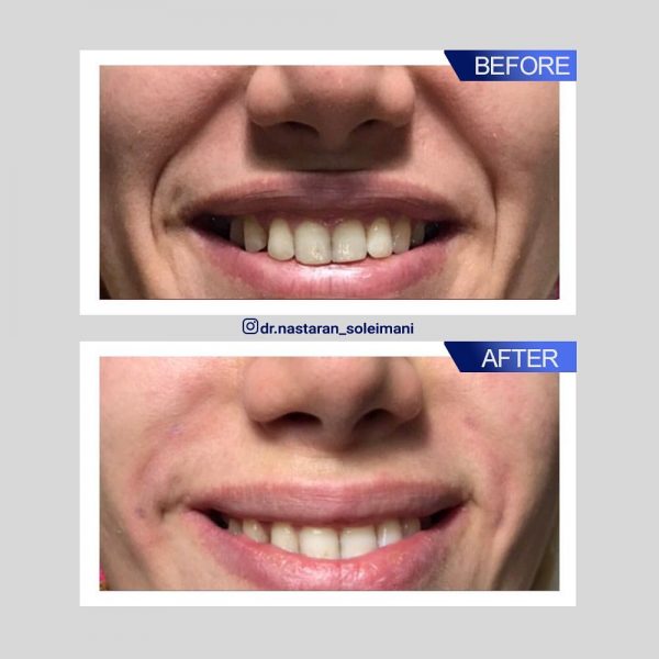 تزریق ژل خط خنده