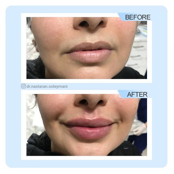 تزریق ژل لب