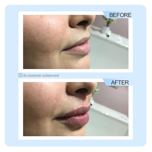 تزریق ژل لب